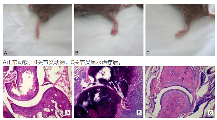 氢水治疗类风湿关节炎的研究