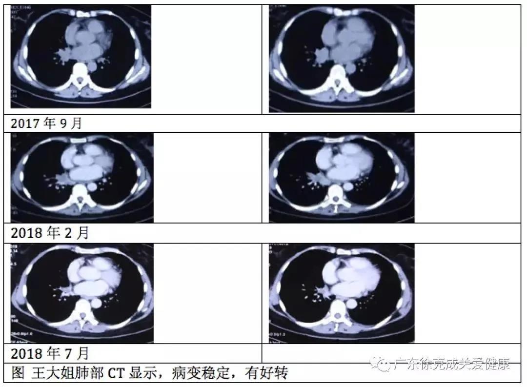 临床报告显示｜吸氢后，肺癌脑转移完全消失了。